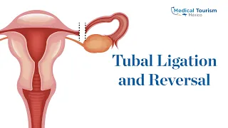 Tubal ligation and Tubal reversal - Medical Tourism Mexico