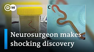 Neurosurgeon removes live worm from woman's brain in world-first discovery | DW News