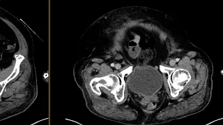 Ileocecal mass