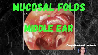 006. Mucosal Folds and spaces  of the Middle Ear  #anatomy of middle ear
