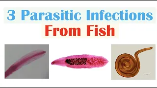 3 Parasitic Infections From Fish (Diphyllobothriasis, Clonorchiasis, Anisakiasis)