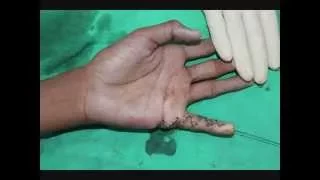 Z plasty for contracture 0001