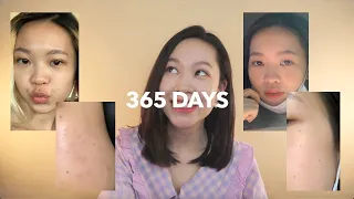 Why I Wear Sunscreen Everyday For 365 Days (Before/After Pictures) | Euodias