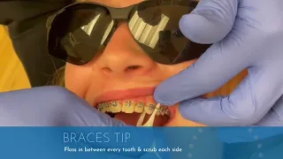 How to Floss Properly with Braces | Jones Family Orthodontics | Monroe, Washington