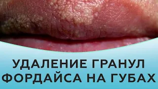 Удаление гранул Фордайса на губах