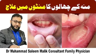 Muh K Chalon Ka Ilaj In UrduHindi  Mouth Ulcers Causes & Treatment  Dr  Muhammad Saleem Malik