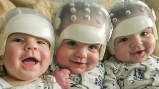 When This Woman Gave Birth To Triplets, Doctors Realized That Something Was Wrong With Their Heads