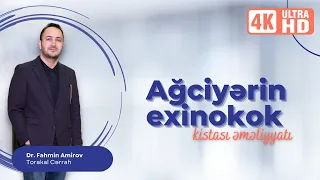 Ağciyərində olan exinokok kistası əməliyyatı