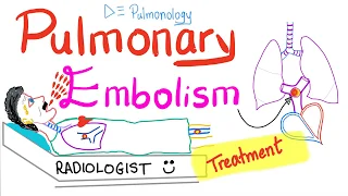 Pulmonary Embolism Management | Thromboembolism | Pulmonology