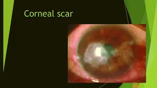 Corneal scar #eye #optometry