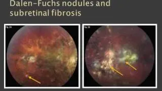 Ophthalmology - Uvea Class2: Common causes of uveitis Part3