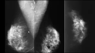 Clinical Implementation of Ultrasound in Breast Imaging