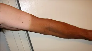 how to get rid of an arm tan lines fast