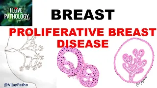 DISEASES OF BREAST Part 2:  PROLIFERATIVE BREAST DISEASE