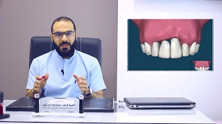 أنواع زراعة الأسنان وأفضلها