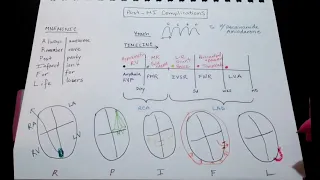 Post-MI Complications for USMLE: Timeline and Mnemonics. What you really need to know.