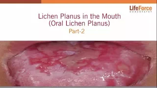 What should you know about Lichen Planus treatment - Part 2/2