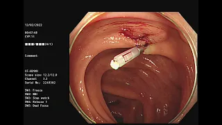 inverted diverticulum, ddx SET