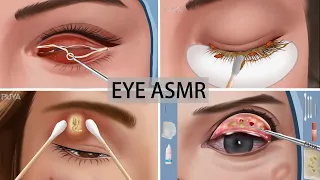 ASMR lashes cleaning|eye mucous removal animation|eye stone removal animation