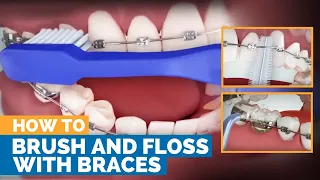 How to Brush & Floss with Braces