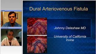 Grand Rounds Supratentorial Arteriovenous Fistulas  Nuances of Technique for Microsurgical Ligation