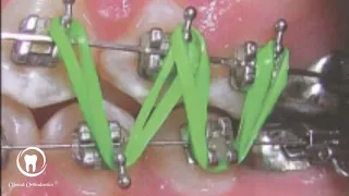 TTT of open bite video 8 : use of intermaxillary elastics
