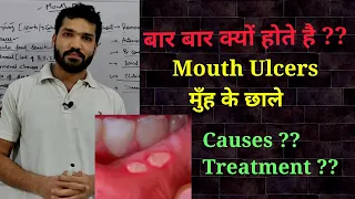 Mouth ulcers , Causes & Treatment ?? मुँह मे छाले होने के कारण ?