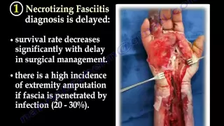 Difficult Necrotizing Fasciitis Part II - Everything You Need To Know - Dr. Nabil Ebraheim