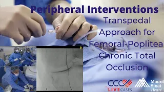 Transpedal Approach for Femoral-Popliteal Chronic Total Occlusion