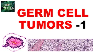 OVARIAN TUMORS -  Part 4: Germ cell tumors:  Dysgerminoma, yolk sac tumor - Pathology