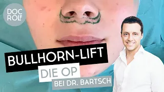 BULLHORN-LIFT – die LIVE OP bei Dr. Rolf Bartsch