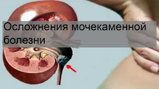 Осложнения мочекаменной болезни