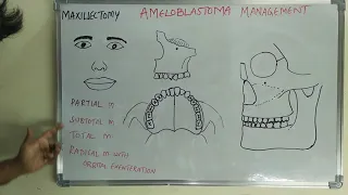 MAXILLECTOMY