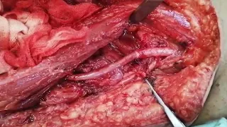 Vascular surgery femoral artery anastomosis