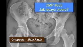 Jak leczyć biodro - przyczyny wewnątrzstawowe | OMP #005