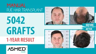 Manual FUE Hair Transplant Result 5042 Graft 1 Year #hairtransplant #saçekimi