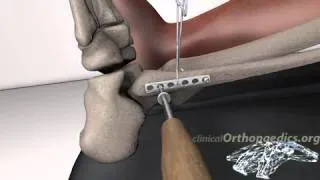Operative treatment of ankle fractures