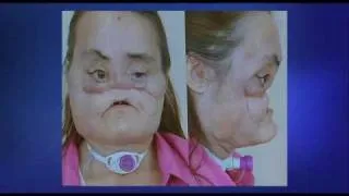 Woman has world's first full face transplant