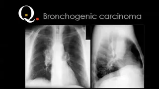 Chest film reading 2013 PART 1   Dr Mamdouh Mahfouz