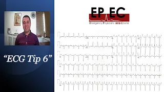 ECG Tip 6. "Is this sinus tachycardia, SVT or flutter?"