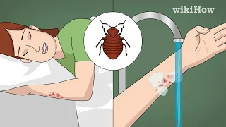 How to Treat Bed Bug Bites