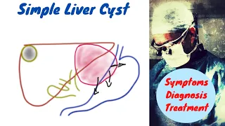 Simple Liver Cyst | Symptoms, Diagnosis and Treatment
