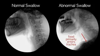 Normal vs Abnormal swallowing