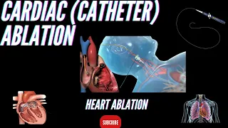 Cardiac (Catheter) Ablation : What is it and how does it help an irregular heart beat?