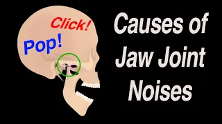 Causes of Jaw Joint Noises: Snap, Crackle, and Pop!