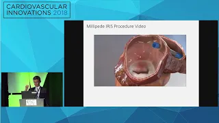 CVI2018 Session: The Top 5 latest innovations in transcatheter MV therapy - Jason Rogers, MD