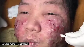 BEST BLACKHEAD AND WHITEHEAD REMOVAL! SEVERE ACNE TREATMENT - SATISFYING AND RELAXING VIDEO