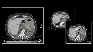 Bowel Trauma | Interesting Radiology Cases