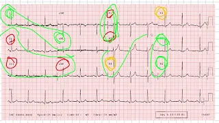 Perustason perehtyjä jakso 2: 12-16 -kanavaisen EKG:n tulkinta