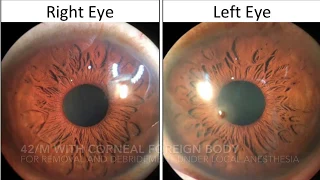 Corneal Foreign Body Removal and Debridement